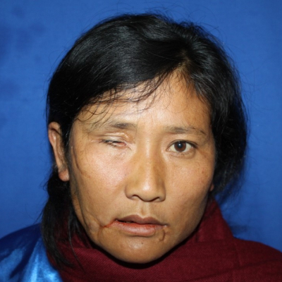 2014 Bhutan Patient 1