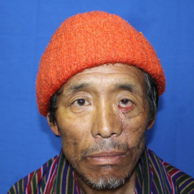 2015 Bhutan Patient 4