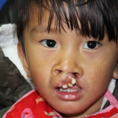 2015 Bhutan Patient 5