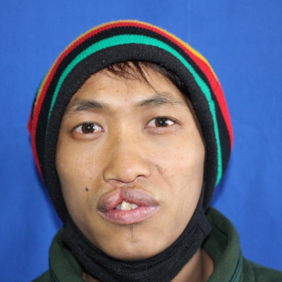 17 Bhutan Patient 1