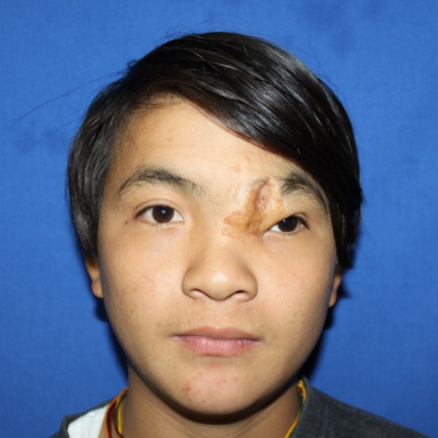 2014 Bhutan Patient 2
