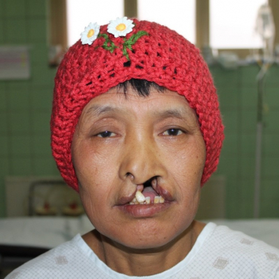 2014 Bhutan Patient 3