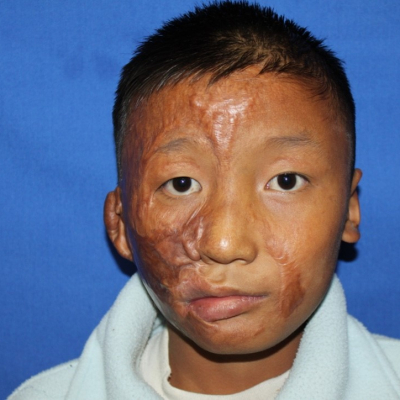 2014 Bhutan Patient 4