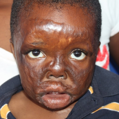 2014 Zambia Patient 1