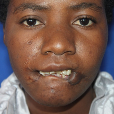 2014 Zambia Patient 2