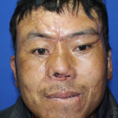 2015 Bhutan Patient 2