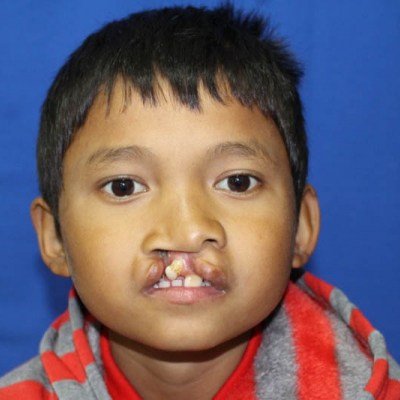 2015 Bhutan Patient 3