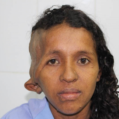 2015 Honduras Patient 1
