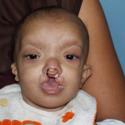 2015 Honduras Patient 3