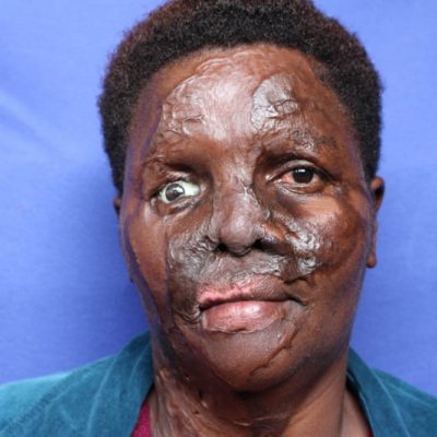 2015 Uganda Patient 1