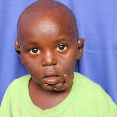 2015 Uganda Patient 3