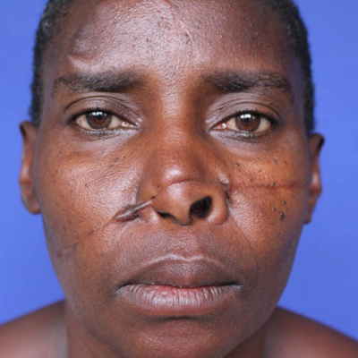 2015 Uganda Patient 4