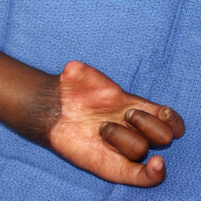 2015 Uganda Patient 5