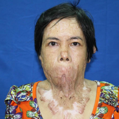 2015 Vietnam Patient 4