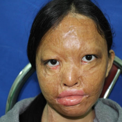 2015 Vietnam Patient 6