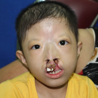 2015 Vietnam Patient 7