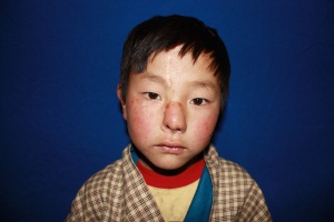 7-year old Tandin Dorji before his second surgery for to reconstruct his nose after a bob cat attack. 